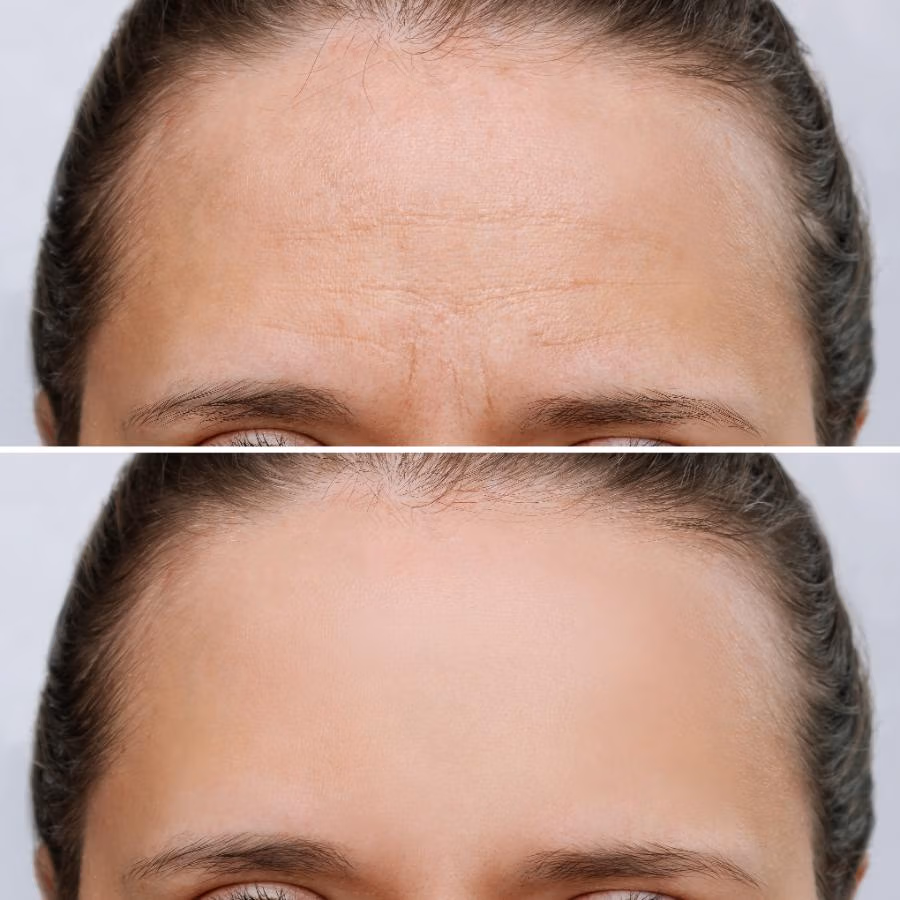 BOTOX BA