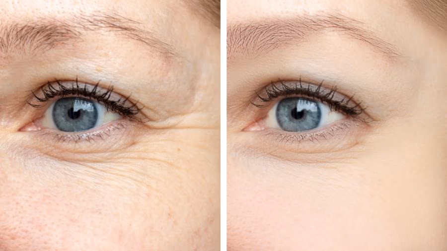 BOTOX BEFORE AFTER