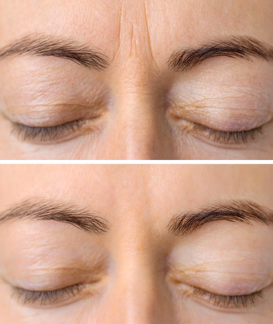 BOTOX BEFORE AND AFTER