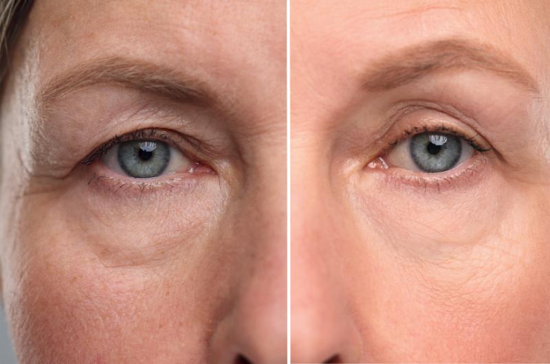 PRP-undereye-before-after
