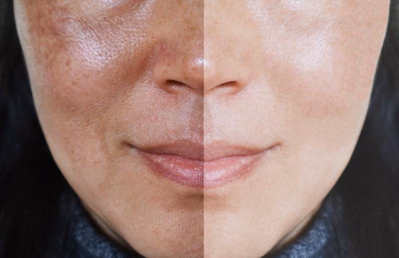 chemical-peel-before-after