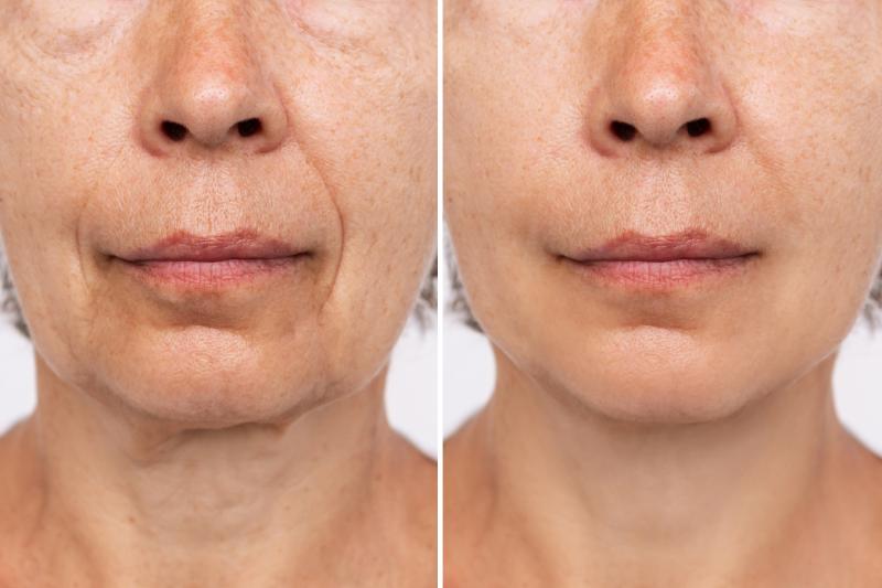 dermal-fillers-before-after