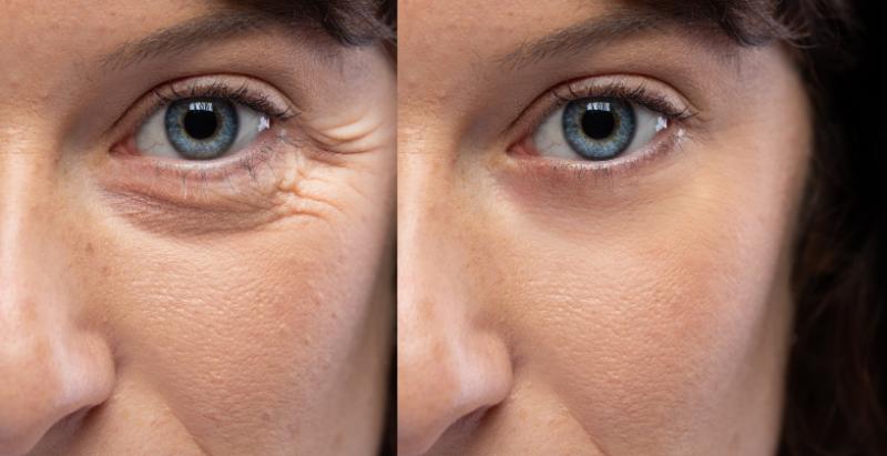 dermal-fillers-under-eyes