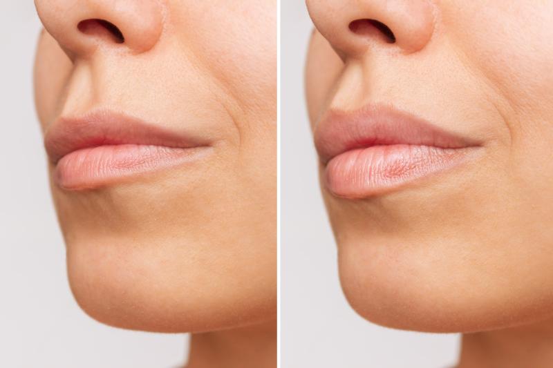 lip-filler-before-after (1)