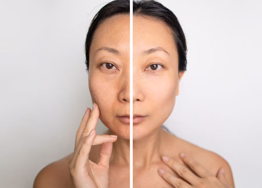 microneedling-before-after-