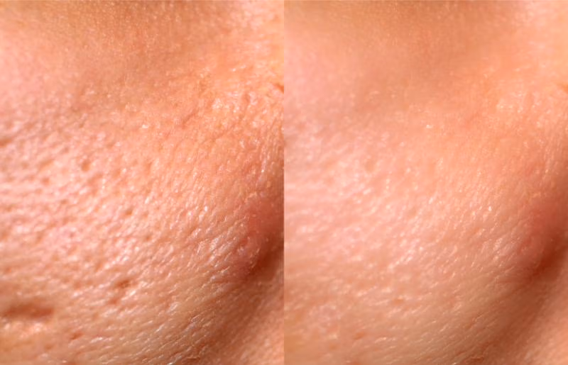microneedling-reduced-pores