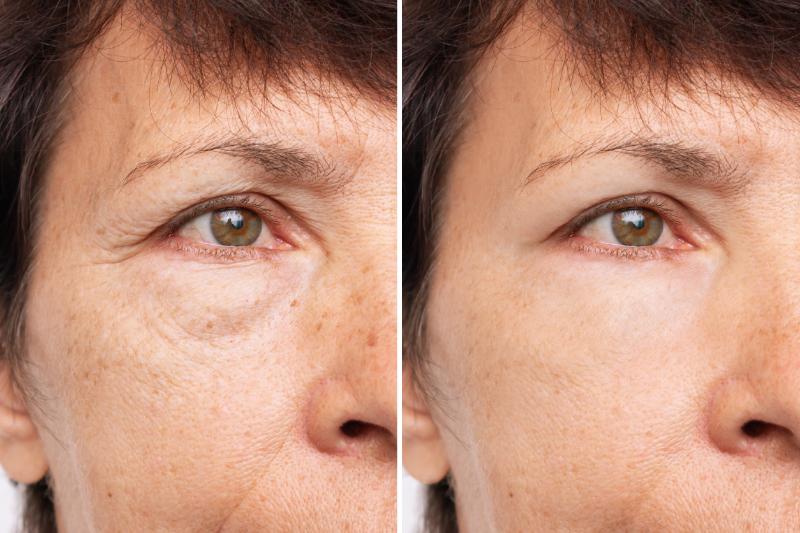 prp-puffy-eyes-results
